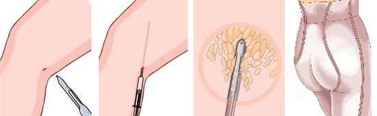 腿型塑造