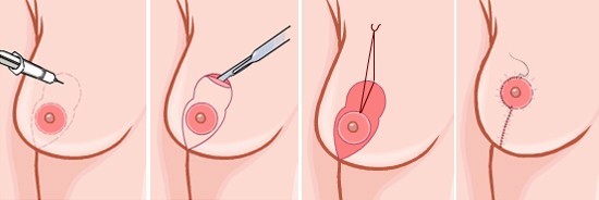 乳房下垂矫正