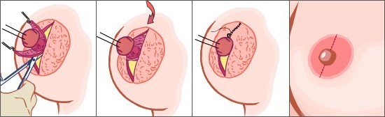 乳头乳晕矫正