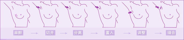 假体隆胸